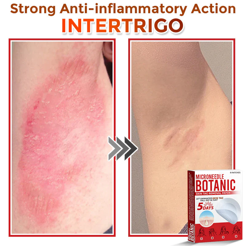 MicroNeedle Botanic Skin Tag Removal Patch