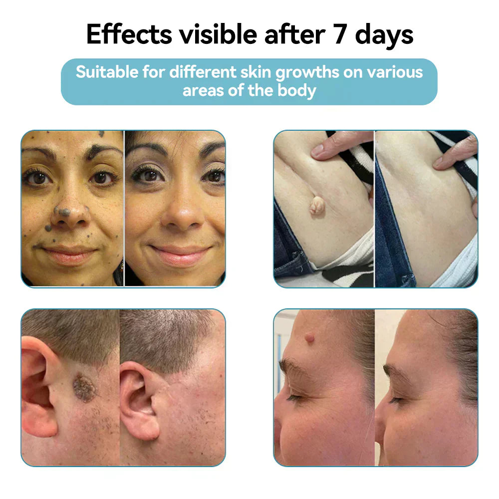 ✨EETTSY™ All-in-One CO₂ Laser Eraser Pen | Removes Moles, Warts, Skin Flaws & Pigmentation