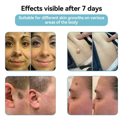 ✨EETTSY™ All-in-One CO₂ Laser Eraser Pen | Removes Moles, Warts, Skin Flaws & Pigmentation