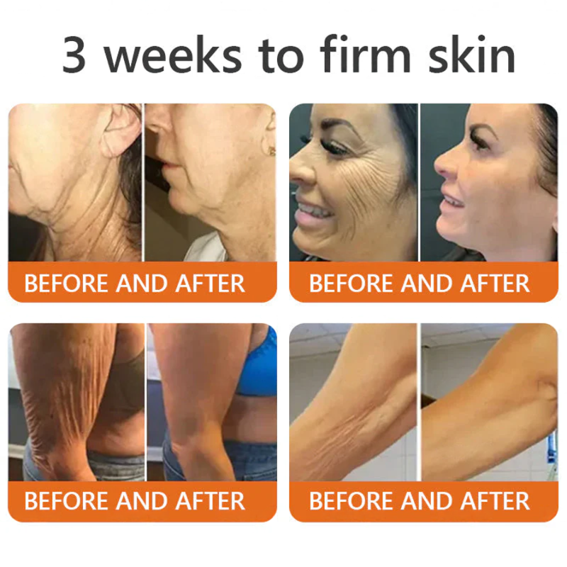 Botox Bee Venom Skin Restoration Cream - Anti-aging, Hydrating, Skin Firming & Lifting, Skin Repair, Even Tone, Acne and Dark Spot Treatment, Wart and Mole Removal, and Psoriasis Relief.