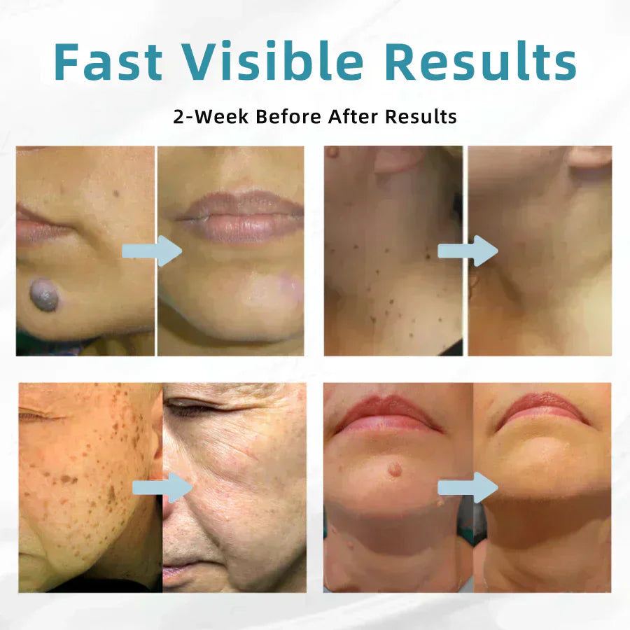 ✨EETTSY™ All-in-One CO₂ Laser Eraser Pen | Removes Moles, Warts, Skin Flaws & Pigmentation