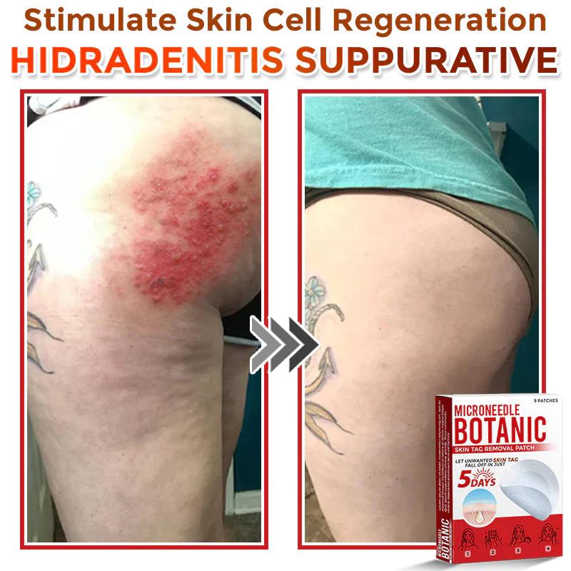 MicroNeedle Botanic Skin Tag Removal Patch