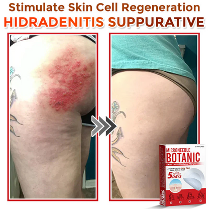 MicroNeedle Botanic Skin Tag Removal Patch