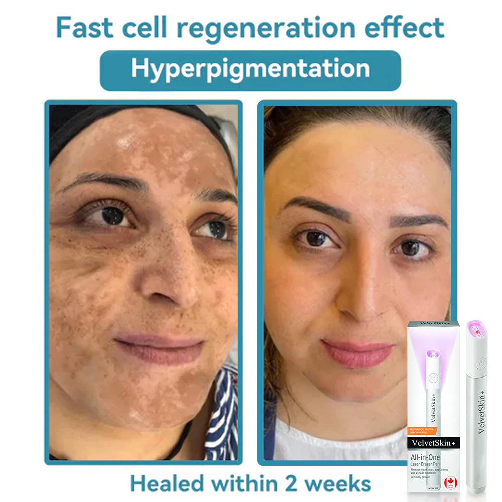 ✨EETTSY™ All-in-One CO₂ Laser Eraser Pen | Removes Moles, Warts, Skin Flaws & Pigmentation