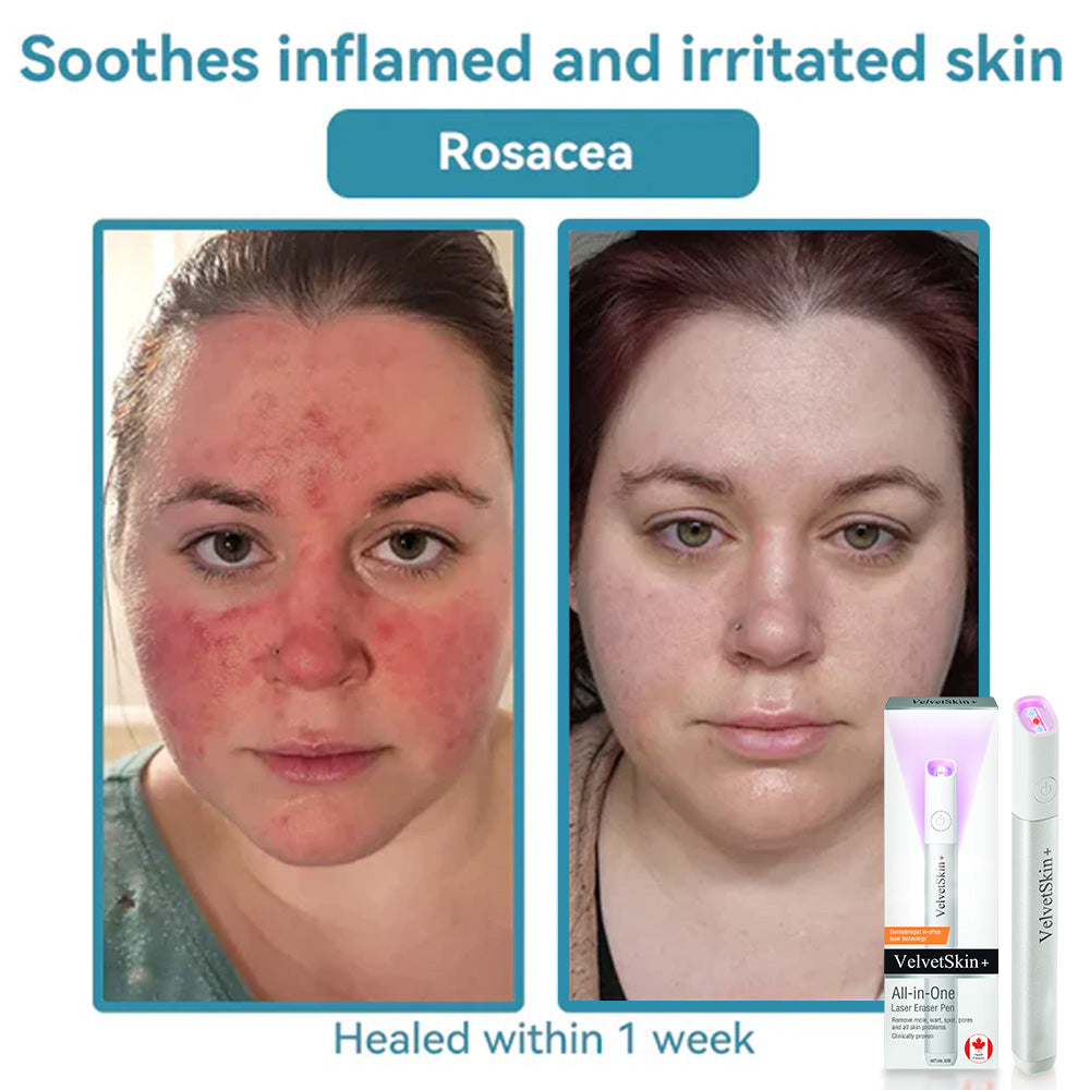 ✨EETTSY™ All-in-One CO₂ Laser Eraser Pen | Removes Moles, Warts, Skin Flaws & Pigmentation