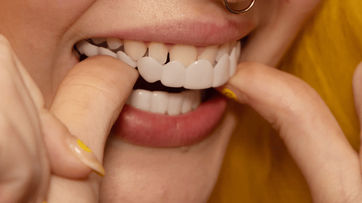 LumaGrin Instant Snap-On Veneers For Upper and Lower Teeth
