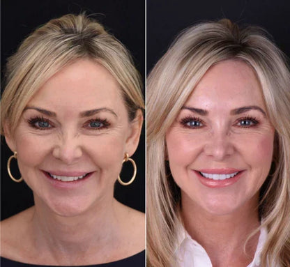 NovaBright Snap On Veneers For Upper And Lower Teeth Instant Natural Smile