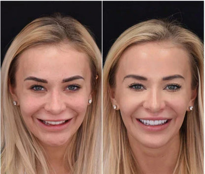 NovaBright Snap On Veneers For Upper And Lower Teeth Instant Natural Smile