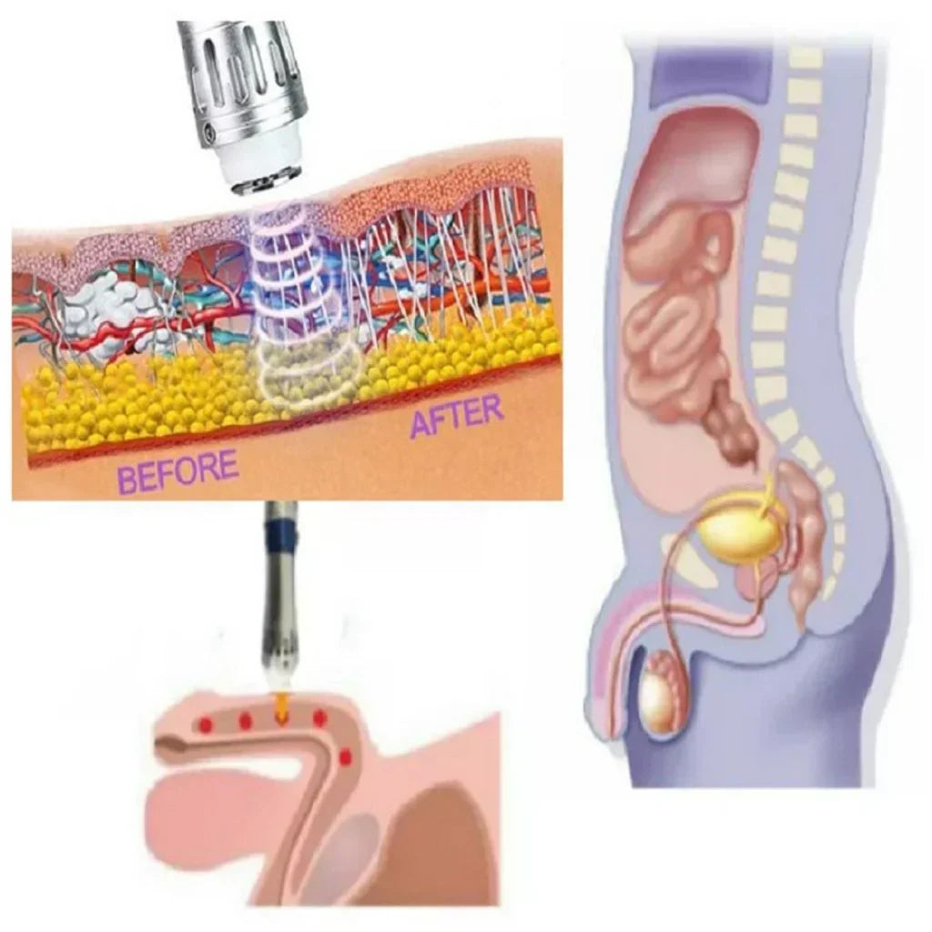 VitaPulse Portable ED Shockwave Therapy Device for Men